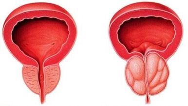 healthy and inflamed prostate with prostatitis