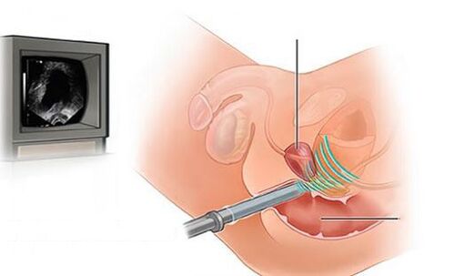 Ultrasound of the prostate